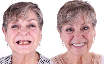 Before and After of an All-on-4 Procedure