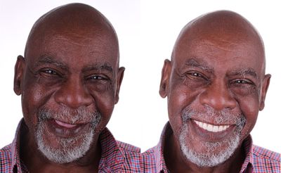 Before and After of an All-on-4 Procedure