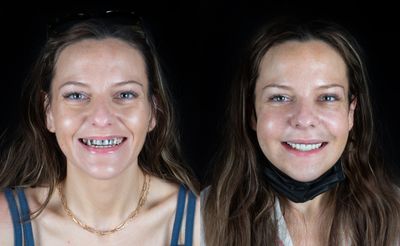 Before and After of an All-on-4 Procedure