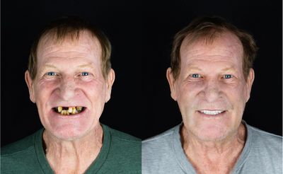 Before and After of an All-on-4 Procedure